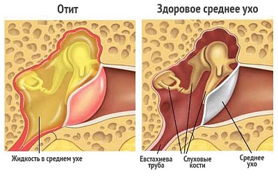 Хронічний отит середнього вуха