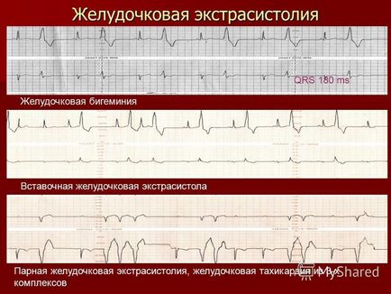 Extrasistolul ventricular - cauze, simptome, tratament