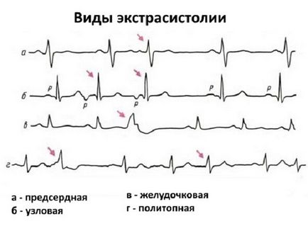 Extrasistolul ventricular - cauze, simptome, tratament