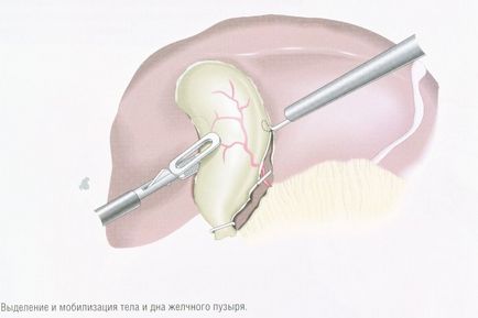 ЖКХ хронічний холецистит