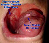 Neoplasm malign de diagnosticare a amigdalelor, tratament