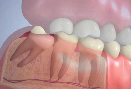 Мъдрец - на симптоми, отстраняване, снимка, какво да се прави, ако мъдрец боли