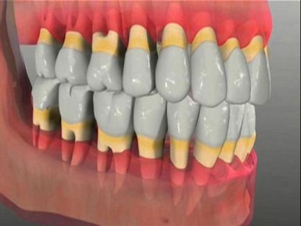 Pasta de dinti de la boala parodontala, care este mai bine sa alegi o fotografie si un video