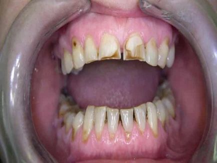 Pasta de dinti de la boala parodontala, care este mai bine sa alegi o fotografie si un video