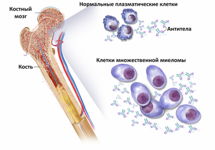 4. előállítás A myeloma multiplex kezelésében kezelés Izrael