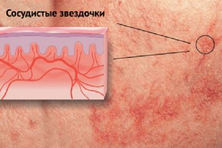 7 Методів лікування судинних зірочок на ногах - здорове довголіття