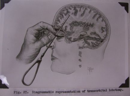 8 Fraza faptelor despre lobotomie - factum