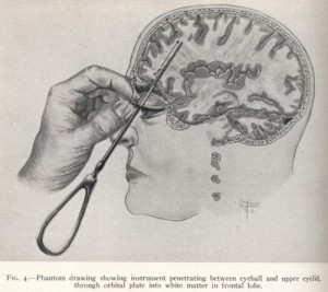 8 Жахливих фактів про - лоботомии