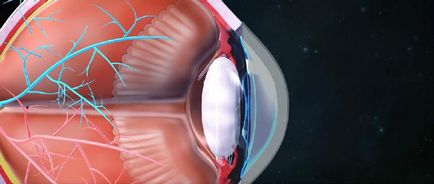 Dispunerea lentilelor de ochi - mecanism și tulburări de pe site