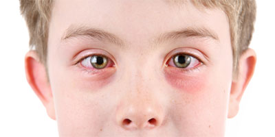 Алергічний кон'юнктивіт лікування, симптоми, фото, у дітей, причини