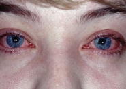 Allergiás kötőhártya-gyulladás kezelésére, a tünetek, fotó, gyermek, az okok