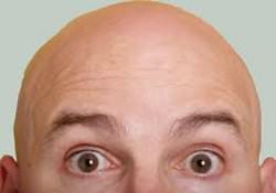 Alopecia androgenică și adenomul prostatic