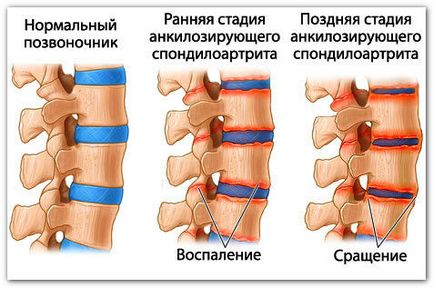 Spondilita anchilozantă (spondilita anchilozantă) - cauze, patogeneză, simptome, diagnostic, tratament,