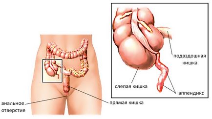 Апендицит в бременността симптоми и ефекти