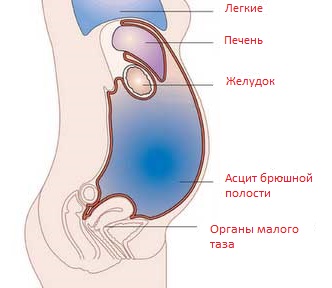 Ascite în cauzele bolii hepatice, simptome, etape și tratament