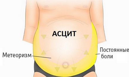 Ascite în cauzele bolii hepatice, simptome, etape și tratament