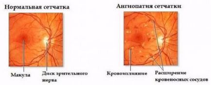 Ateroscleroza simptomelor bolii retiniene si tratament