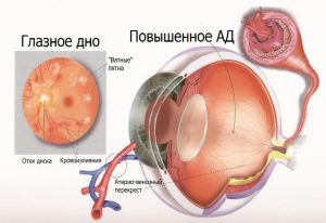 Ateroscleroza simptomelor bolii retiniene si tratament