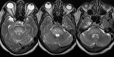 Atherosclerosis retina betegség tünetei és a kezelés