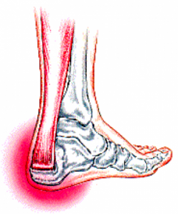 Achillotendinita - ce a cauzat boala