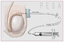 Biopsie testiculară