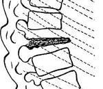 Boala Calve - cauze, simptome, diagnostic și tratament