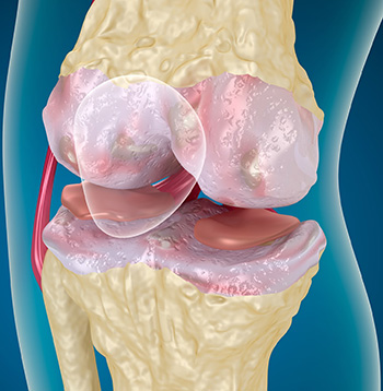 Біль і набряклість коліна причини і лікування колінного суглоба хондропротекторами після