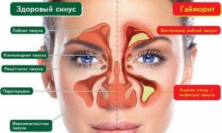 Capul și fruntea doare la o rinită, frig ceea ce trebuie făcut sau făcut