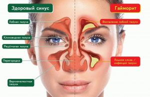 Болить перенісся при нежиті, ознаки синуситу