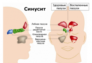 Podul nasului doare, semnele sinuzitei