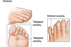 A fájdalom a lábában után futni (Arthritis az ízületek a láb) A fájdalom a lábában után futni