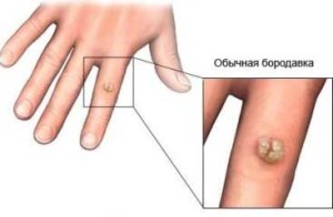 Negii la copil pe mâini - cauze, tipuri, tratament, prevenire