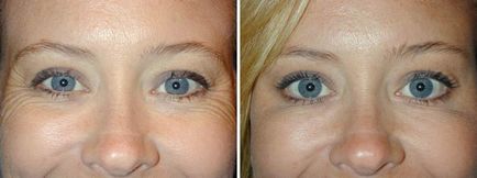 Botox în jurul ochilor: indicații și contraindicații pentru injecție