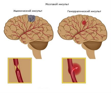 Orvosi Prevenciós Központ - október 29. - elleni harc világnapja szélütés