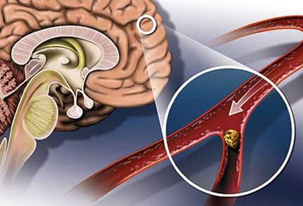 Centrul de Prevenire Medicală - 29 octombrie - Ziua Mondială Împotriva Accidentului Stroke