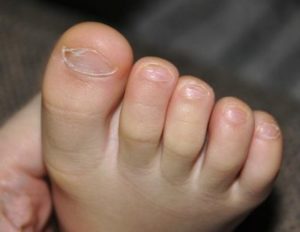 Чим лікувати грибок у дітей на ногах