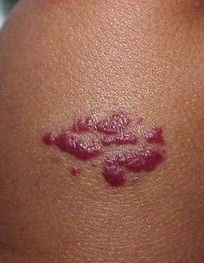 A veszélyes haemangioma (vér-betegség) Mennyire veszélyes hemangioma