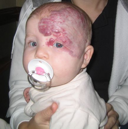A veszélyes haemangioma (vér-betegség) Mennyire veszélyes hemangioma