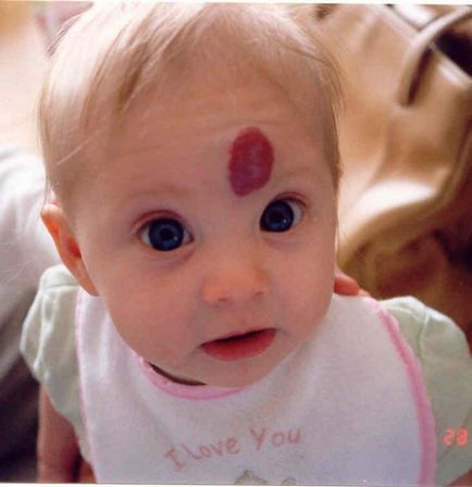 A veszélyes haemangioma (veszélyes) Mennyire veszélyes hemangioma