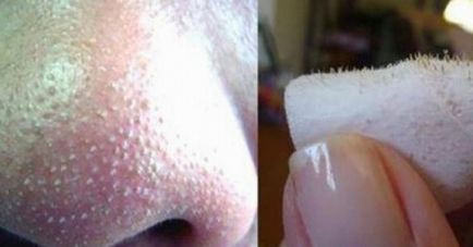Mai degrabă pentru a elimina acnee în condiții de casă - cum să curățați punctele negre pe un nas - rețete în condiții de casă