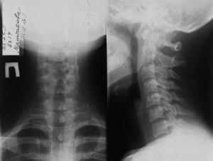 Ceea ce arată razele X ale coloanei vertebrale cervicale, instabilitatea cervicală