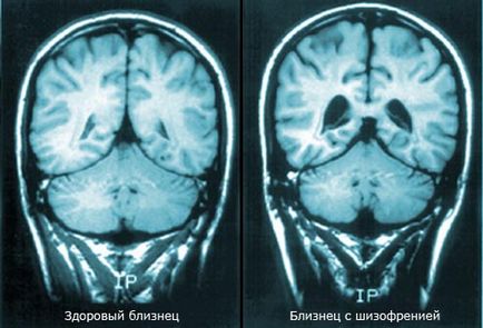 Mi a skizofrénia, a tünetek és a kezelés
