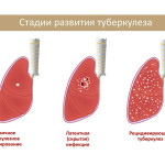 Циклодинон при лікуванні кісти яєчника вплив Циклодинону на гормони, Вєркін щоденник