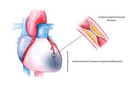 Stenozarea simptomelor de ateroscleroză și tratamentul