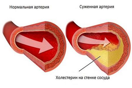 Ctenoziruyuschy atherosclerosis tünetek és a kezelés