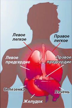 Dextracardia cu transpunerea organelor la copii