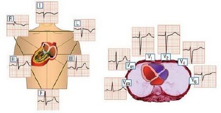 Dextrocardia și repolarizarea pe ect