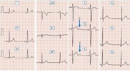 Dextrocardia și repolarizarea pe ect