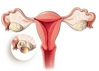 Chistul ovarian dermoid - ceea ce este, motivele producerii, diagnosticul diferențial al dermoidului