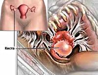 Chistul ovarian dermoid - cauze, simptome, diagnostic și tratament